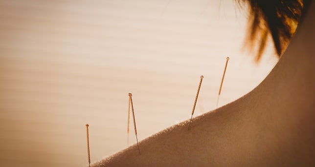 young-woman-getting-acupuncture-treatment-in-thera-2025-04-03-12-55-51-utc 1-min.jpg young-woman-getting-acupuncture-treatment-in-thera-2025-04-03-12-55-51-utc 1-min.jpg