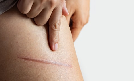 female-leg-with-thermal-burn-of-the-skin-domestic-2025-03-13-00-45-07-utc 1-min.jpg female-leg-with-thermal-burn-of-the-skin-domestic-2025-03-13-00-45-07-utc 1-min.jpg