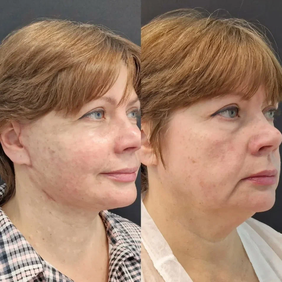 платизмопластика (3)-min.jpg платизмопластика (3)-min.jpg